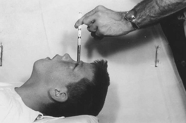 Лоботомия, которую во многих странах практиковали даже в 20-м веке, состояла из вырезания префронтальной коры — передней части лобных долей мозга. В результате процедуры пациент превращался в овощ. Самое страшное то, что изобретатель префронтальной лоботомии — Антониу Эгаш Мониш — в 1949 году получил Нобелевскую премию в области психологии и медицины «за открытие терапевтического воздействия лейкотомии при некоторых психических заболеваниях».